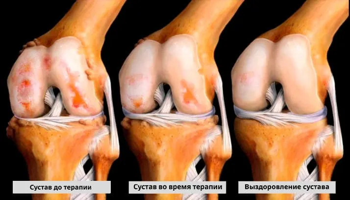 Нанесение крема Arteron на сустав